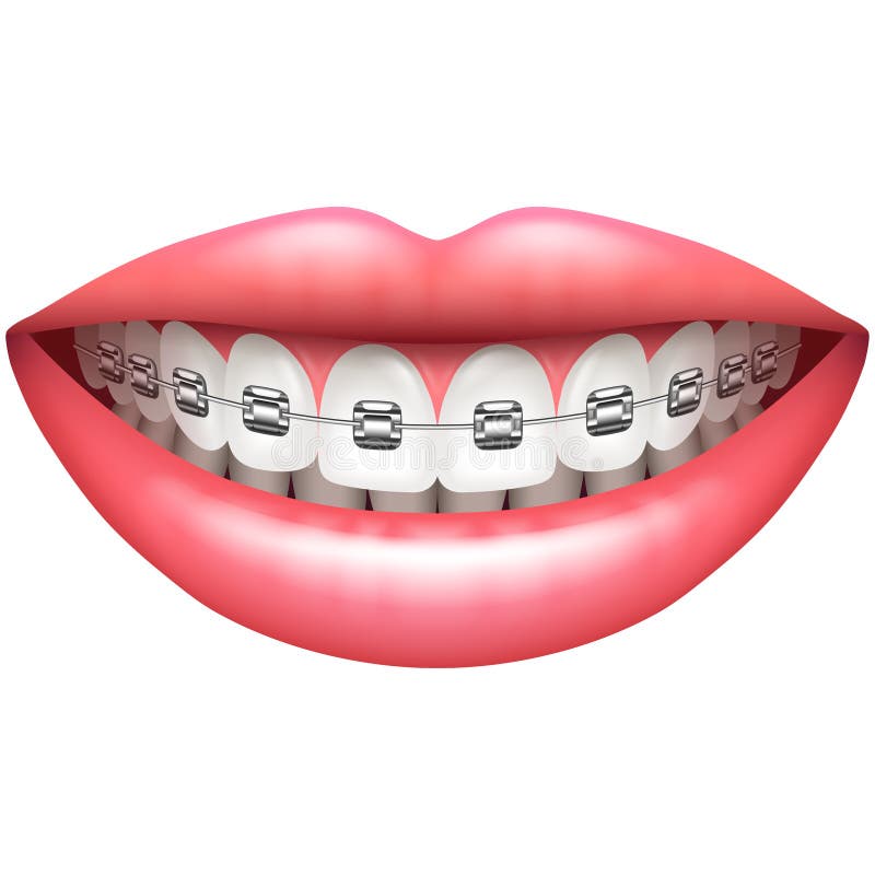 Teeth with braces woman smile isolated on white vector