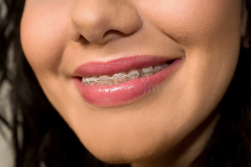 brackets teeth brackets teeth