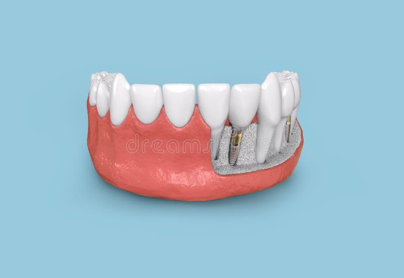 Teeth Dental Implant Model 3d Illustration Stock Illustration