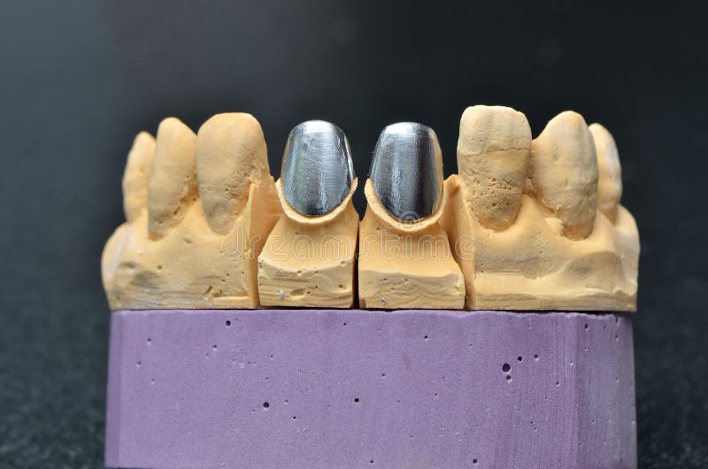 Teeth dental implant model stock photo. Image of implant 35668906