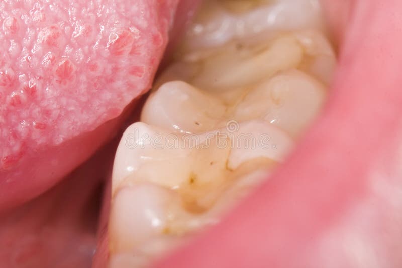 Teeth, Tongue, Tartar, Caries Stock Photo Image of saliva, tooth
