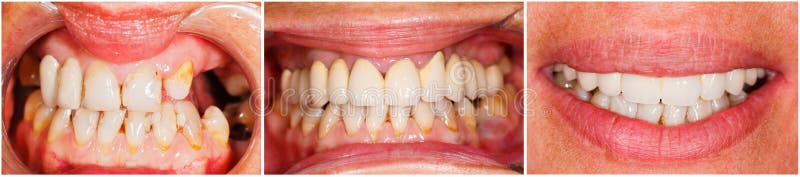 Picture of human teeth before and after dental treatment - beforeafter series. Picture of human teeth before and after dental treatment - beforeafter series.