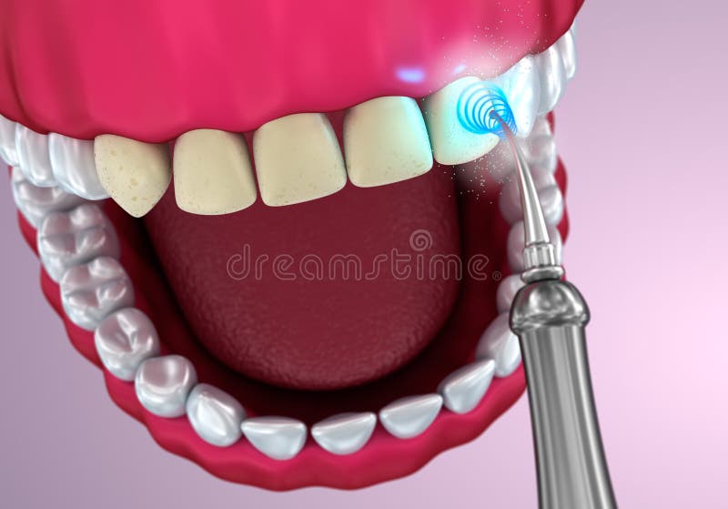 Teeth Whitening , Medically Accurate Illustration Stock Illustration