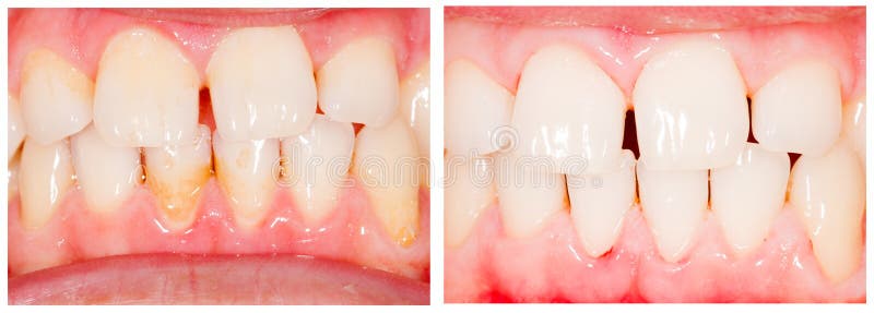 Teeth before and after tooth whitening treatment - beforeafter series. Teeth before and after tooth whitening treatment - beforeafter series.