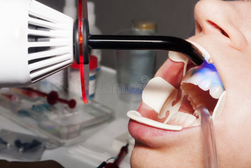 Dental Mouth Spreader, Before Teeth Whitening Stock Photo Image of