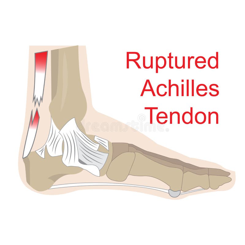 Vector illustration of achilles tendon rupture. image of foot anatomy with all tendons and bones. Vector illustration of achilles tendon rupture. image of foot anatomy with all tendons and bones.
