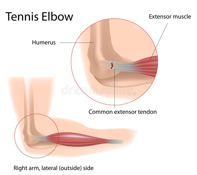 Tennis elbow stock illustration