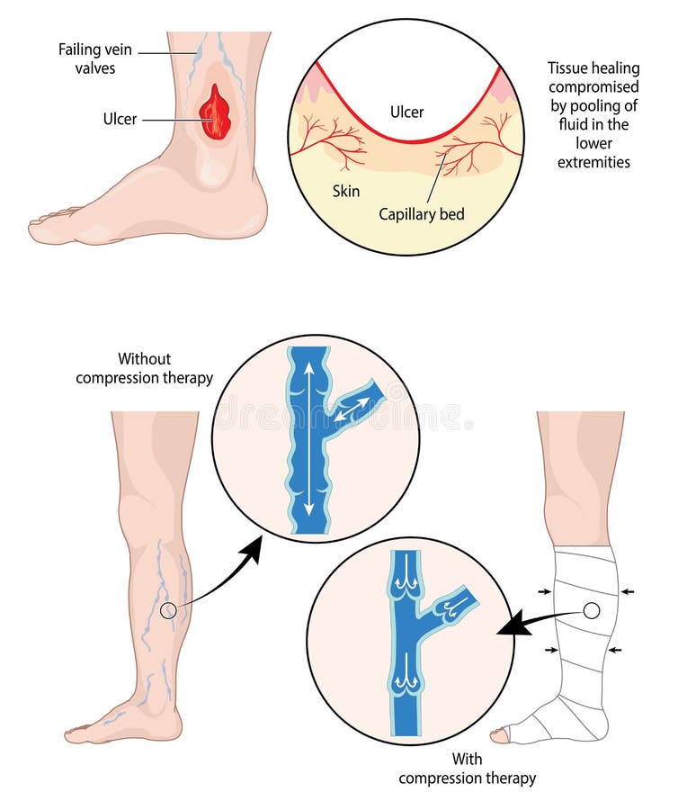 Terapia de la compresión para las úlceras de la pierna