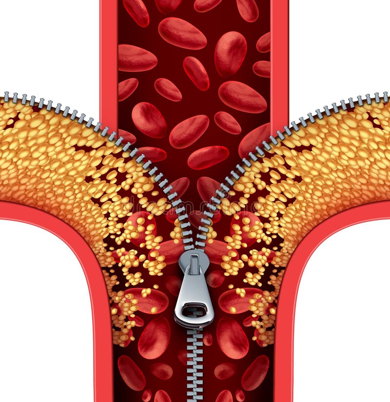 Atherosclerosis therapy cleaning arteries concept as a zipper opening up plaque buildup in a blocked artery as a symbol of medical treatment cleaning clogged veins as a metaphor for removing cholesterol. Atherosclerosis therapy cleaning arteries concept as a zipper opening up plaque buildup in a blocked artery as a symbol of medical treatment cleaning clogged veins as a metaphor for removing cholesterol.