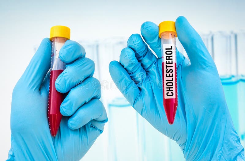 Testtube with Blood Sample for CHOLESTEROL Test Stock Image Image of