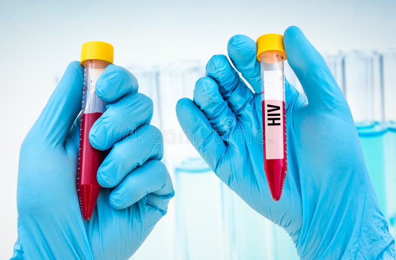 Testtube with Blood Sample for HIV or AIDS Test Stock Image Image of