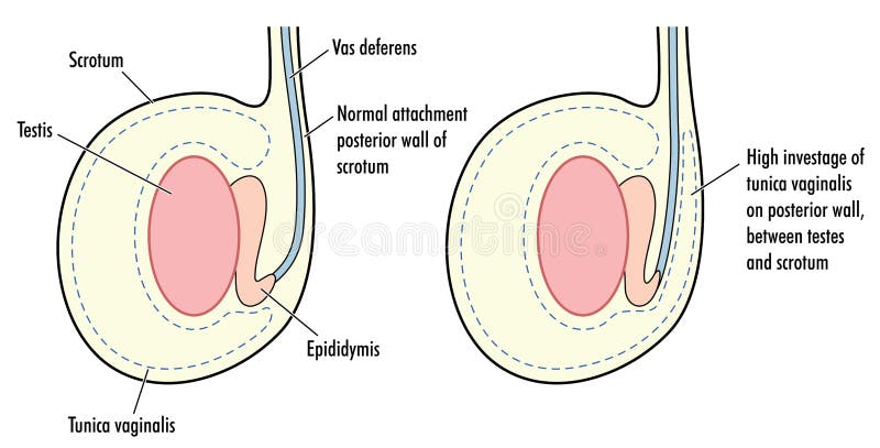 Testicolo normale e testicolo con gli alti vaginalis del tunica illustrazione di stock Testicolo normale e testicolo con gli alti vaginalis del tunica illustrazione di stock