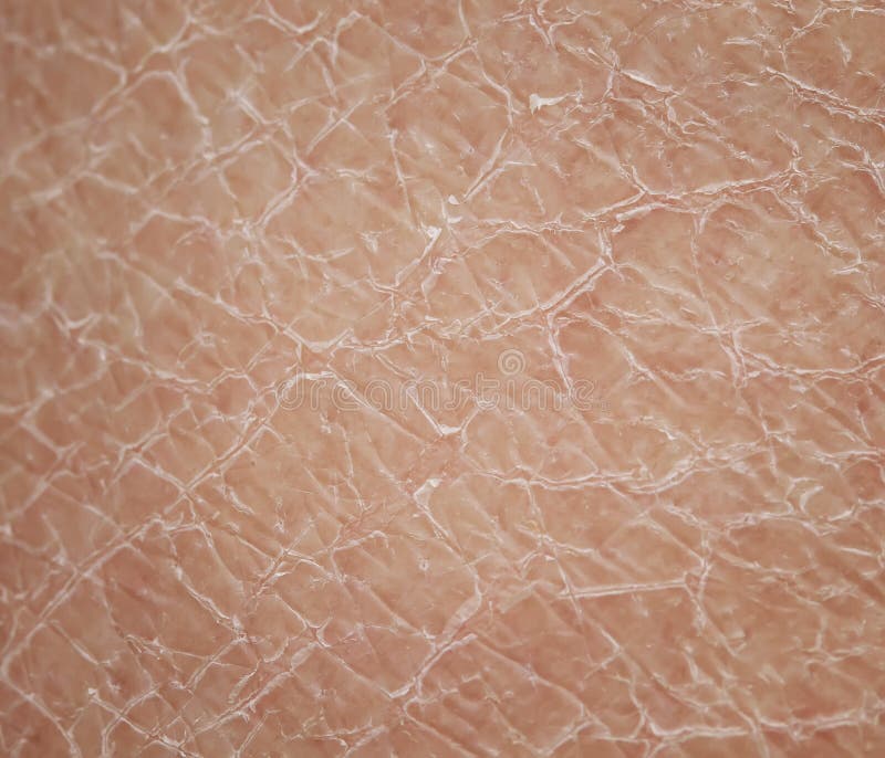 Texture close - up human skin with dermatological problems of dr