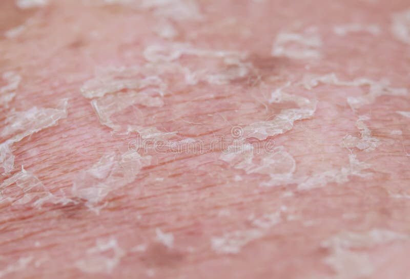 Textured background with scales of dead skin cells with redness and pigmentation after sunburn are detached from the body. Background with scales of dead skin royalty free stock images