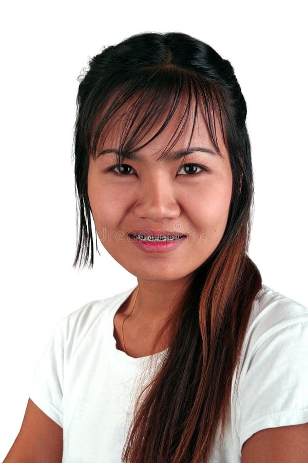 10 Best Clinics For Braces In Thailand 2021 Prices