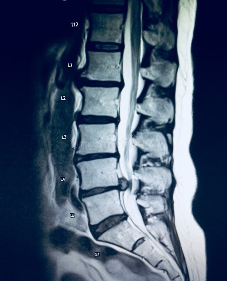 There is pathology of lumbar spine on the level of L4- L5 discs where herniation severely compressed cauda equina revealed by MRI and due to this patient suffering with permanent pain in the back and pelvis . There is pathology of lumbar spine on the level of L4- L5 discs where herniation severely compressed cauda equina revealed by MRI and due to this patient suffering with permanent pain in the back and pelvis .