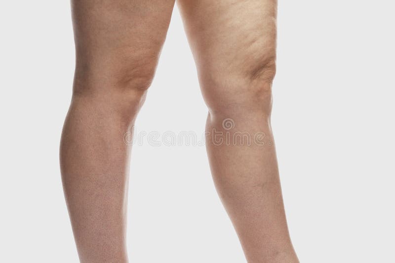 Thick female legs with cellulite and varicose veins. Overweight and disease. Close-up.  on a light gray background