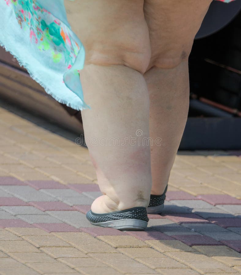 399 Obese Woman Cellulite Legs Stock Photos - Free & Royalty-Free