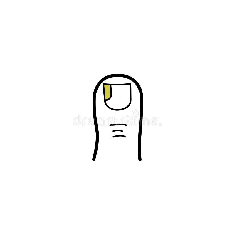 Thigh toe affected nail fungus, yellow finger nail discoloration illustration medical icon royalty free illustration Thigh toe affected nail fungus, yellow finger nail discoloration illustration medical icon royalty free illustration