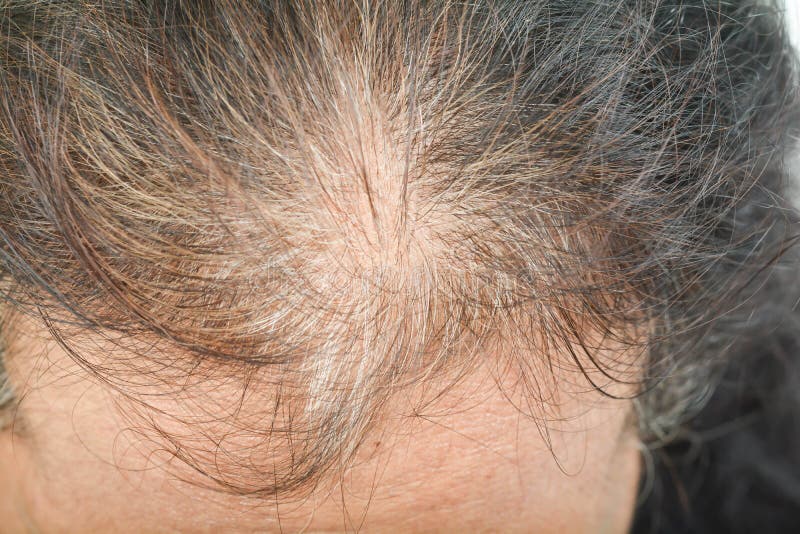 451 Itching Scalp Stock Photos - Free & Royalty-Free Stock Photos from Dreamstime 451 Itching Scalp Stock Photos - Free & Royalty-Free Stock Photos from Dreamstime