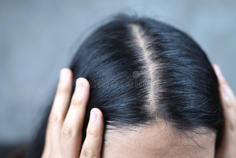 Women with Thin Hair Caused by Hair Loss Symptoms Stock Image - Image of  symptoms, haircut: 209766855