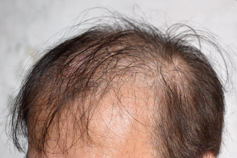 Thinning or sparse hair, male pattern hair loss in Asian elder man