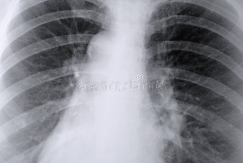 Thorax-Röntgenstrahl der Lungen