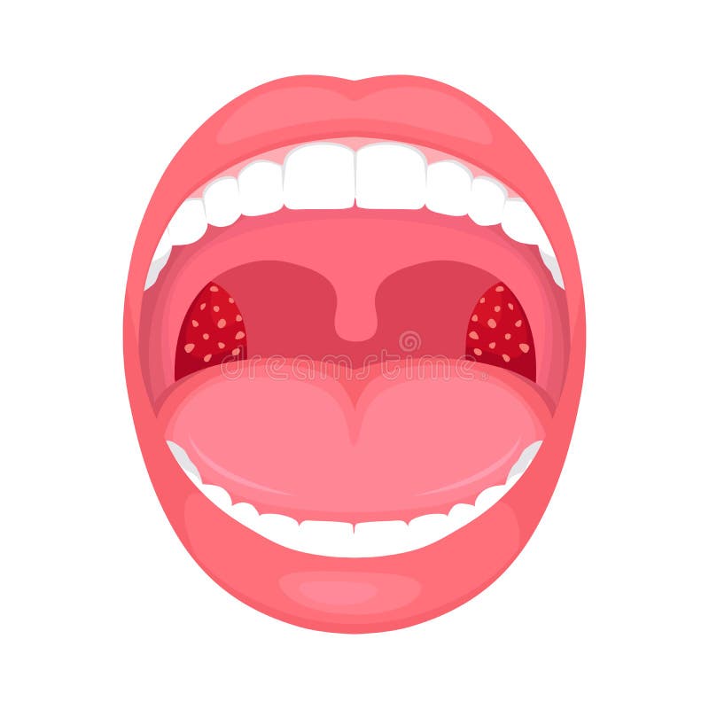 Throat bacterial infection, tonsils inflammation. stock illustration