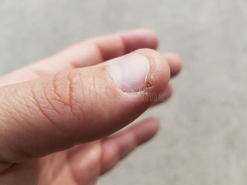 Thumb on hand with short fingernail and small cut or blister royalty free stock images Thumb on hand with short fingernail and small cut or blister royalty free stock images