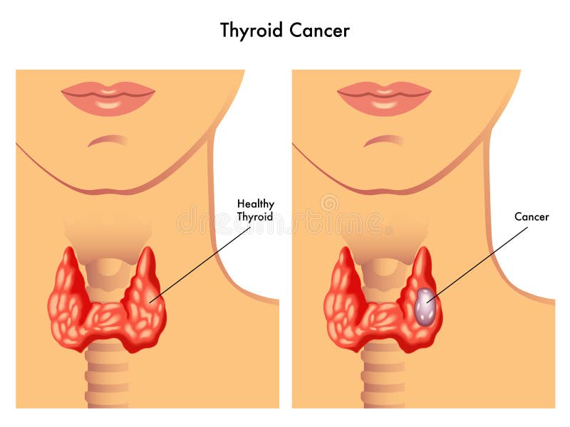 Médico ilustraciones de efectos de glándula tiroides cáncer.