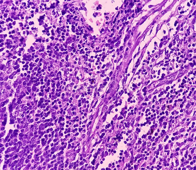 Thyroid Cancer Microscopic Image of Metastatic Papillary Carcinoma of