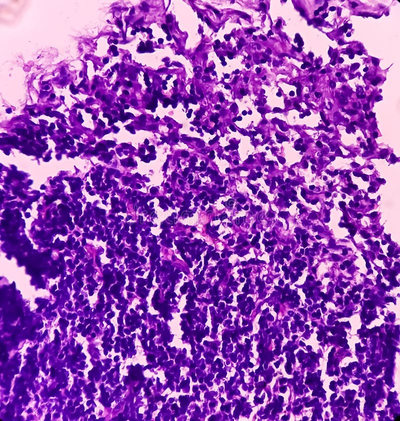 Thyroid Cancer Microscopic Image of Metastatic Papillary Carcinoma of