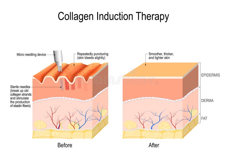 Thérapie d'induction de collagène microneedling la peau