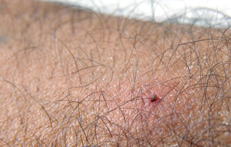 normal tick bite vs lyme normal tick bite vs lyme