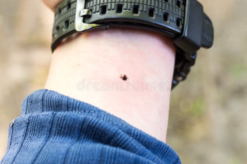 The tick bites his hand. Mite under the skin. The hand of man. royalty free stock photos The tick bites his hand. Mite under the skin. The hand of man. royalty free stock photos