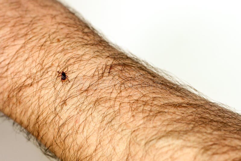 Lyme Borreliosis From A Tick Bite Stock Photo Image Of Migrans Area