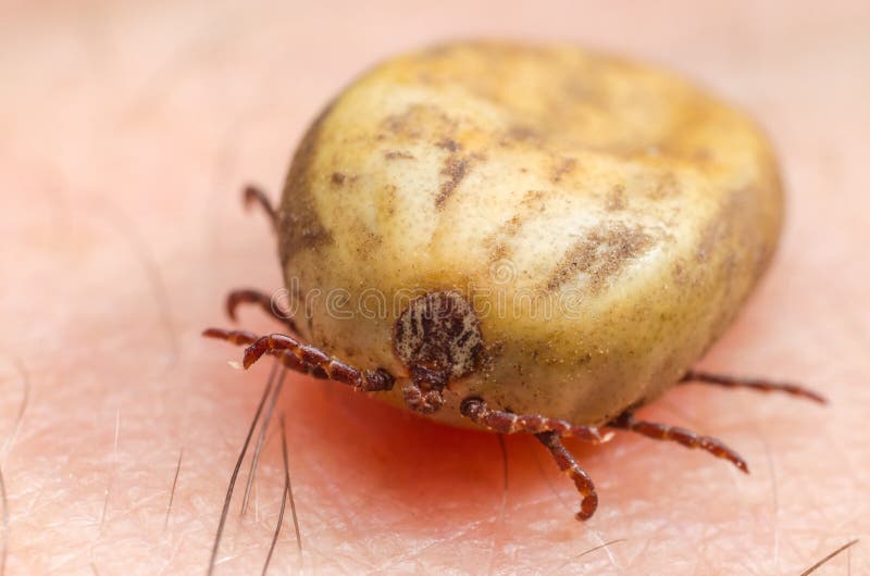 Tick Filled With Blood Sitting On Human Skin Stock Photo Image Of