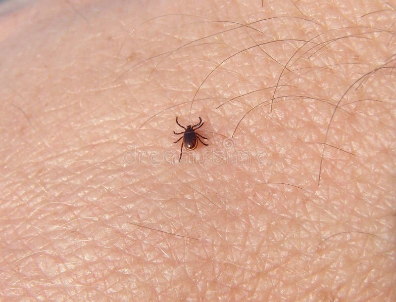 Tick Ixodes Persulcatus Walking on Human Skin Closeup. Stock Photo