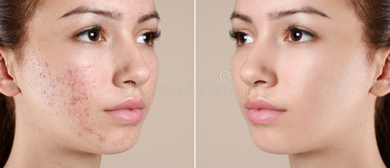 Tienermeisje voor en na een acne-behandeling op achtergrond