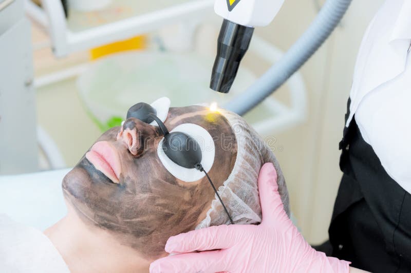 Tillvägagångssätt för skalning för närbildkolframsida Laser pulserar fullständigt hud av framsidan Maskinvarucosmetologybehandlin arkivfoton Tillvägagångssätt för skalning för närbildkolframsida Laser pulserar fullständigt hud av framsidan Maskinvarucosmetologybehandlin arkivfoton