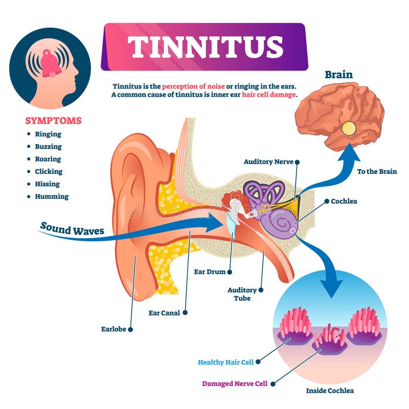 Tinnitus vector illustration. Labeled shingles noise perception ear problem