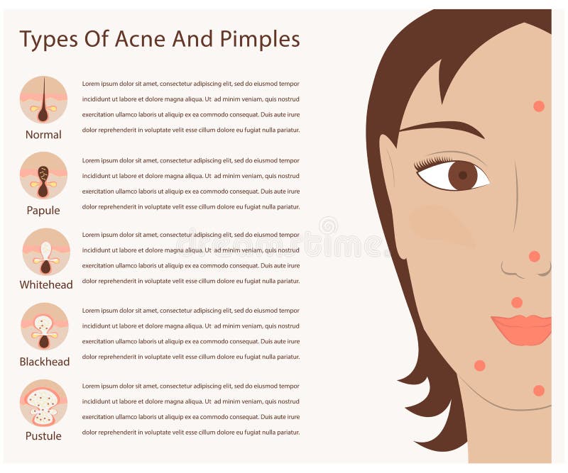 Tipi di acne e di brufoli illustrazione vettoriale Tipi di acne e di brufoli illustrazione vettoriale