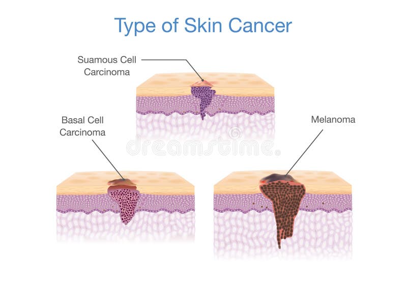Tipo de câncer de pele no estilo do vetor 3D
