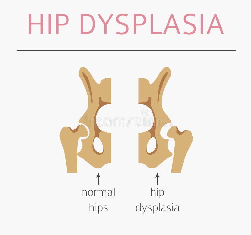 Tipos da deformação do pé, desease médico infographic Dyspla anca ilustração do vetor Tipos da deformação do pé, desease médico infographic Dyspla anca ilustração do vetor