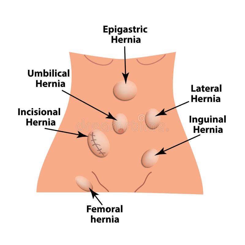 Tipos de hernia Epigástrico, lateral, umbilical, inguinal, femoral, hernia del incisional hernia intestinal Infografía Vector