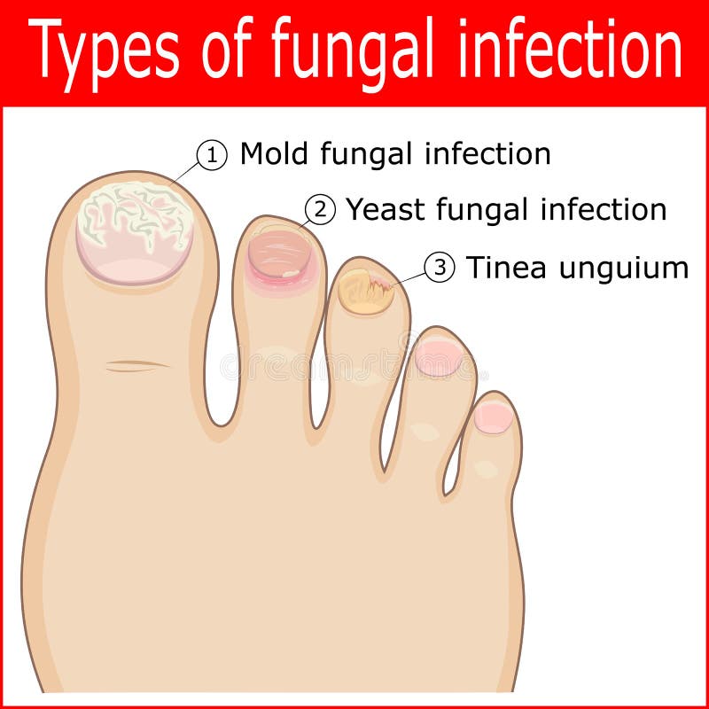 Tipos de infecciones por hongos ilustración del vector Tipos de infecciones por hongos ilustración del vector