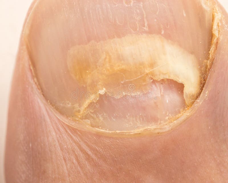 Toe nail fungus on a Big Toe