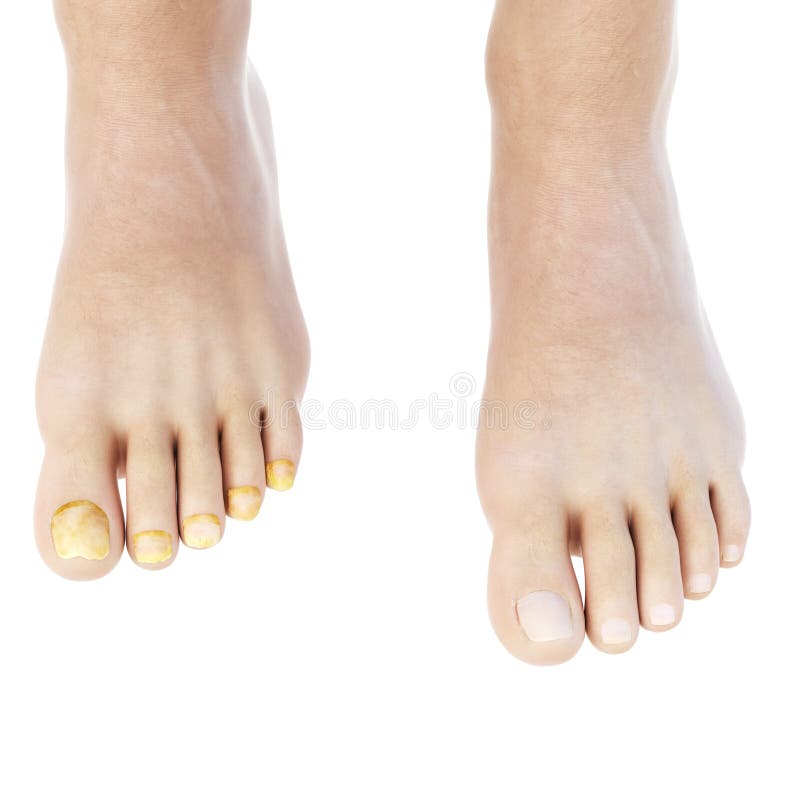 Toe nail fungus