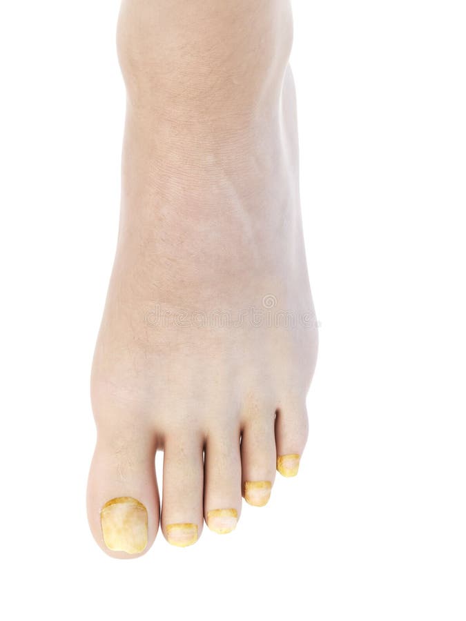 Toe nail fungus