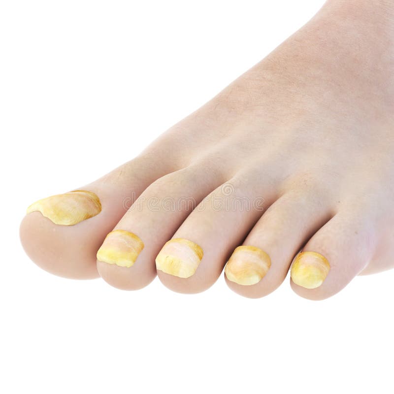 Toe nail fungus